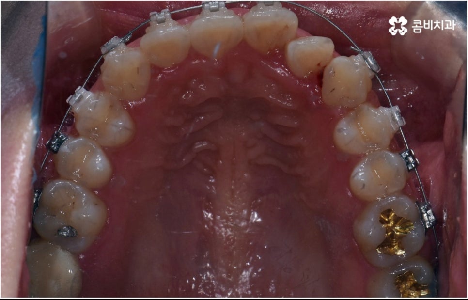 성인 치아교정 기간 걱정이 앞서나요 관련 이미지 9