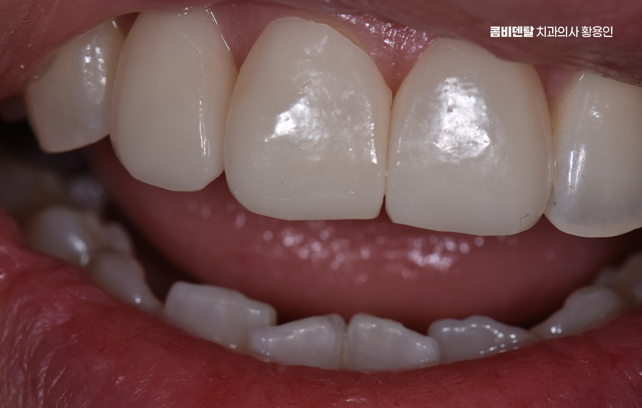 How to Use Laminate Veneers for Chipped Front Teeth image 6