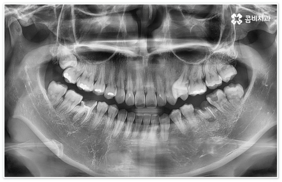 신경치료통증 무섭다고 미루면 관련 이미지 1