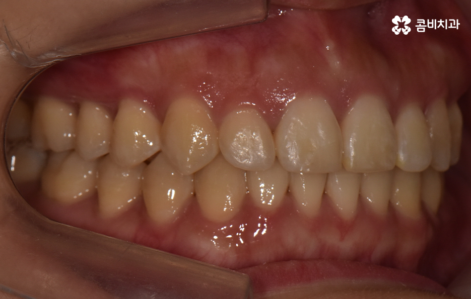 비발치치아교정 고민되는데 발치하면 안좋나요 관련 이미지 12
