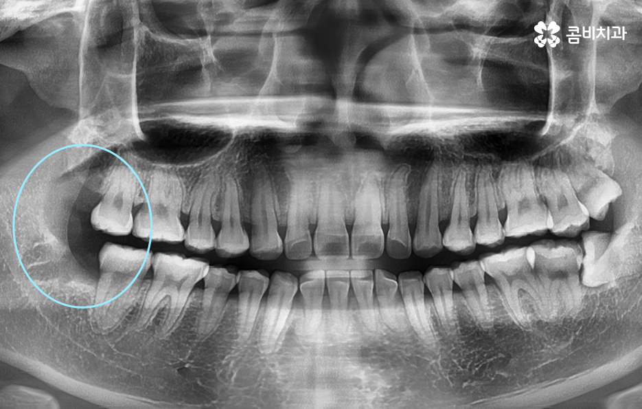 사랑니발치통증 이렇게 해야 쉬워져요 관련 이미지 3