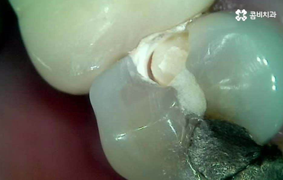 명동치과 놓치기 쉬운 2차충치에 주의하려면 관련 이미지 3