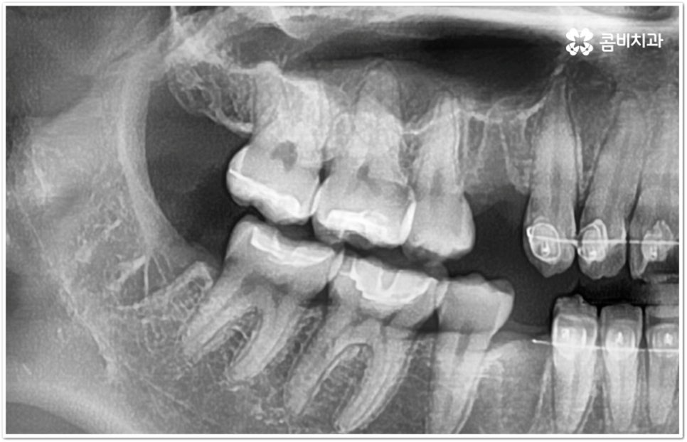 아래사랑니발치 망설이고 있다면 관련 이미지 4