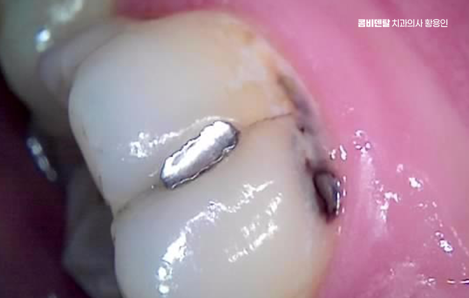치아 시림 통증 갈수록 심해지다면 관련 이미지 13