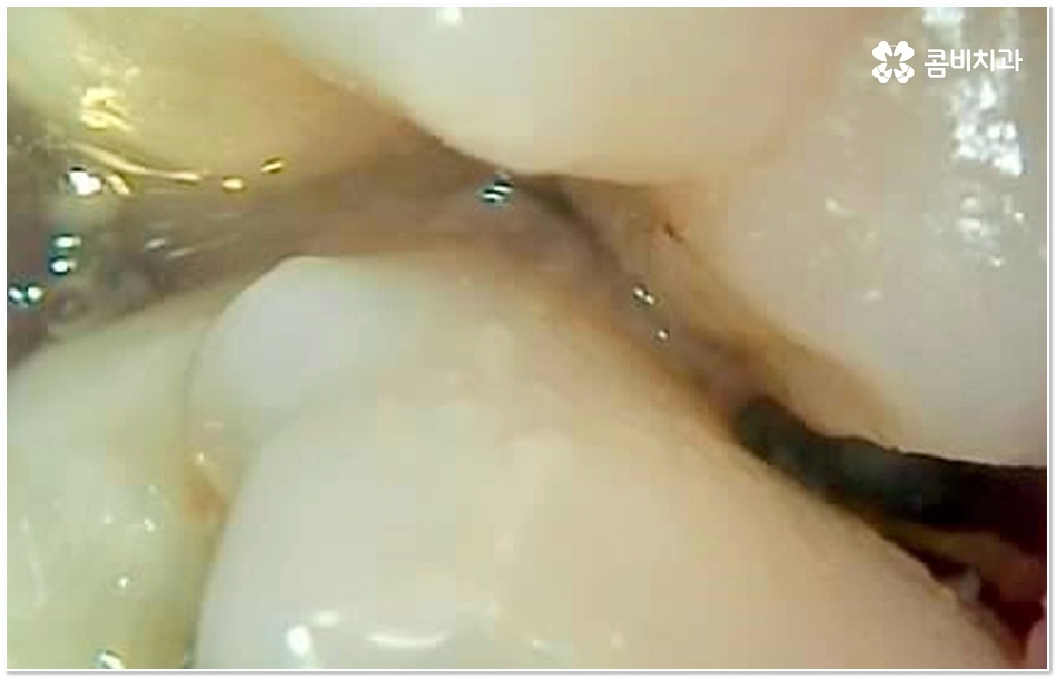 치아 사이 충치 어떻게 하나요 관련 이미지 2
