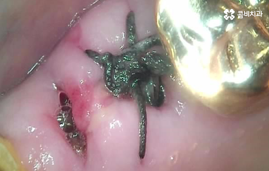 임플란트 치조골 상태에 따라 치료 계획도 달라지나요 관련 이미지 4