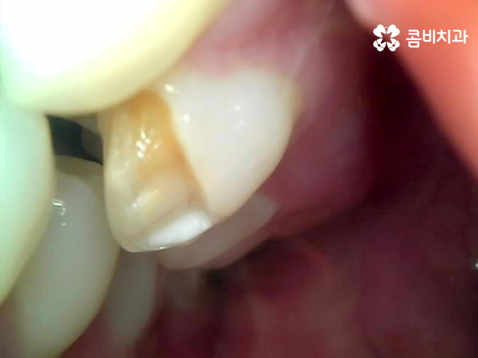 치아 깨짐 다시 튼튼하게 수복하기 위한 방법 관련 이미지 2