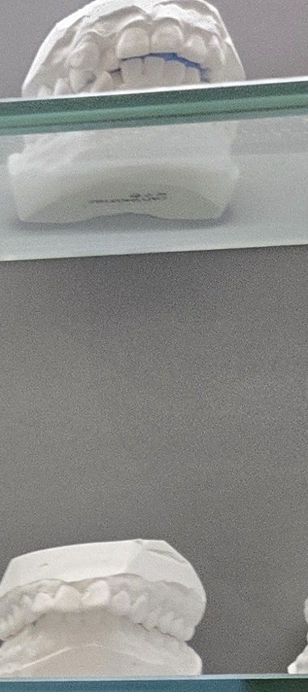 앞이빨 임플란트 과정 주의해야할 포인트는 관련 이미지 15