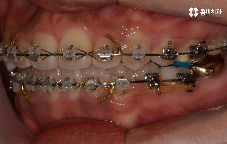 클리피씨교정 알아볼 때 꼭 신경 써야 하는 점은! 관련 이미지 10
