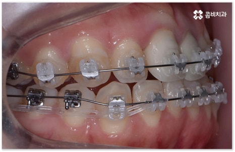치아교정장치 어떻게 고르나요 관련 이미지 7