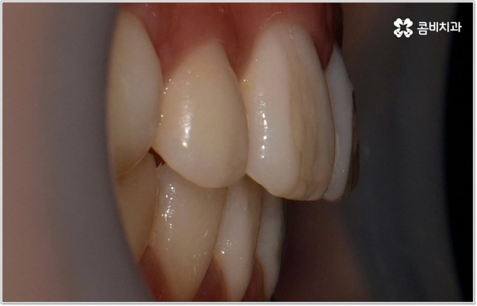 돌출입치아교정 언제가 적기인가요? 관련 이미지 12