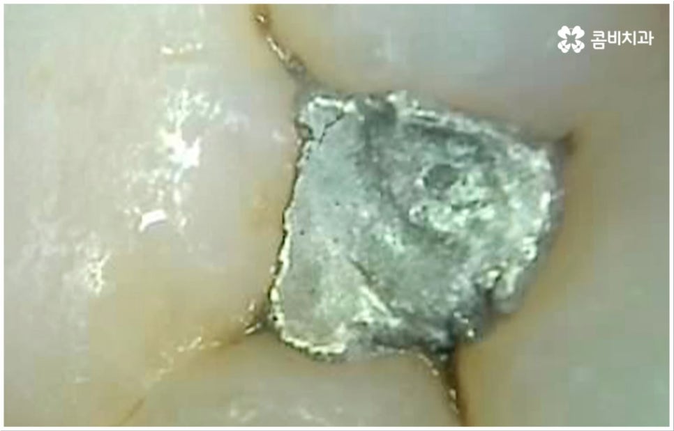 충치 통증 참지마세요 관련 이미지 8