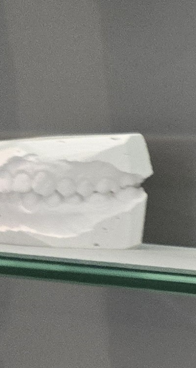 윗니 전체 임플란트 뭐부터 해야할까 관련 이미지 22