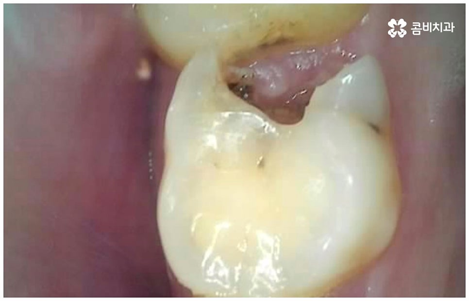 어금니신경치료 케이스마다 달라요 관련 이미지 3