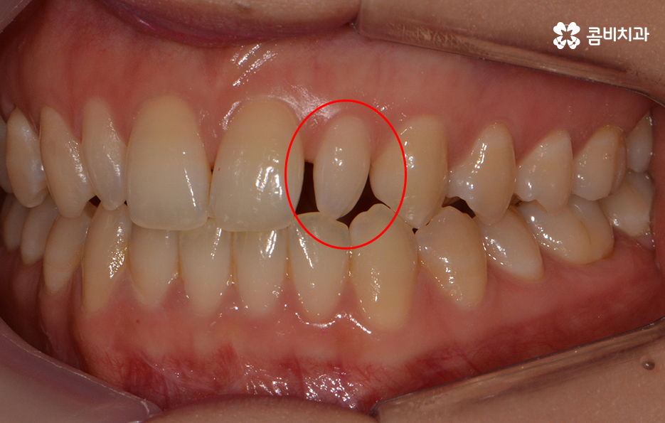 앞니 깨짐 치료와 교정이 병행되었던 사례 관련 이미지 3