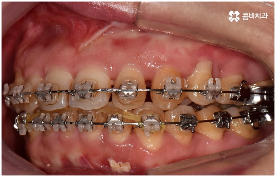 반대교합교정 늦지 않았어요 관련 이미지 14