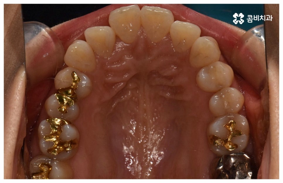 중년치아교정 원한다면 관련 이미지 5
