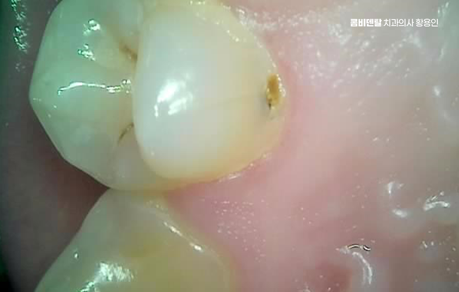 명동치과 흔하게 놓치는 사례를 정리해요 관련 이미지 4
