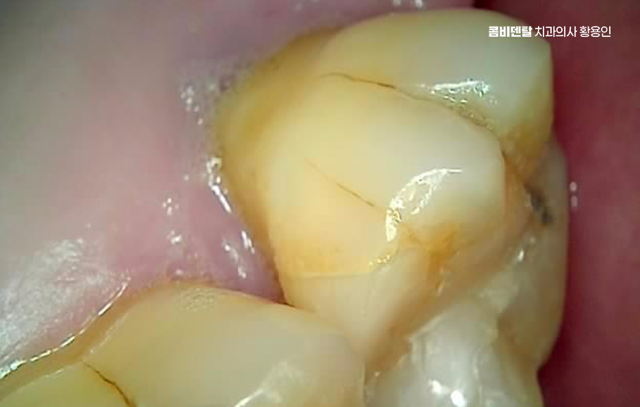 40대 임플란트 이대로 괜찮을까 관련 이미지 3