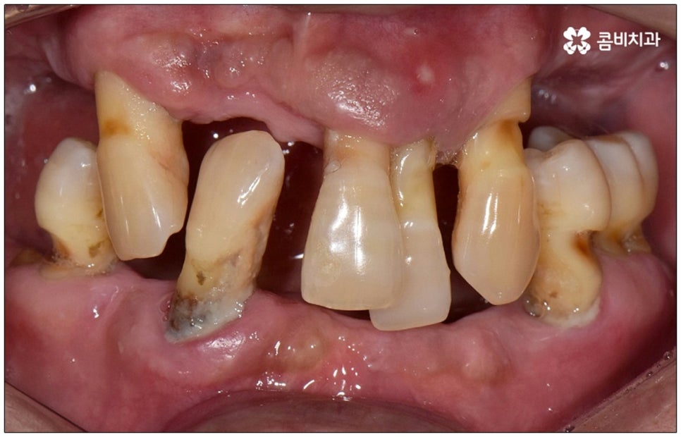 노인임플란트 참고사항 알아봐요 관련 이미지 3
