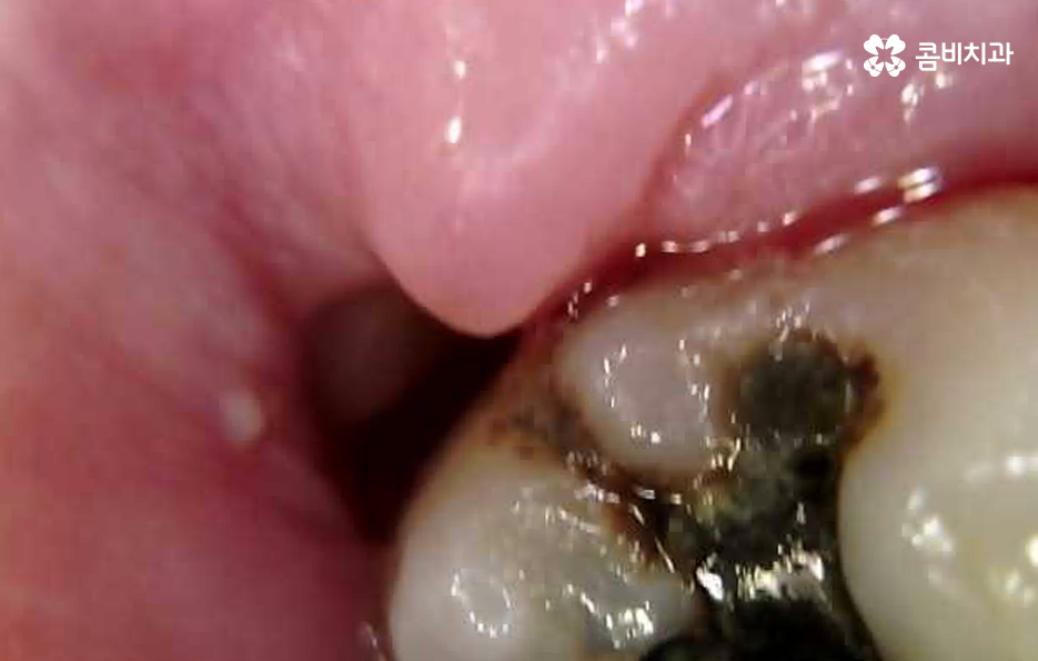 어금니 충치치료 깔끔하게 해결하려면 관련 이미지 7