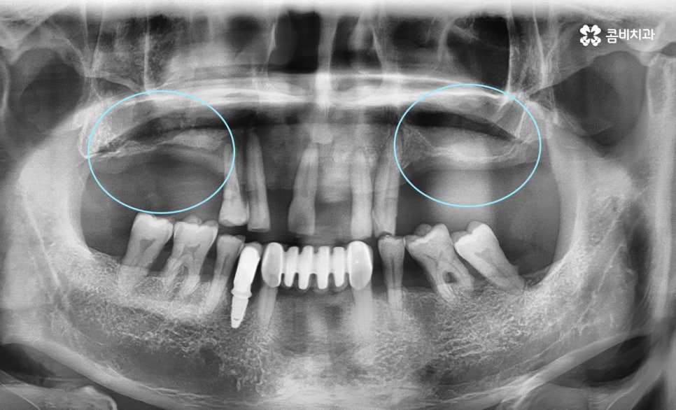 임플란트 수술 여전히 결코 간단하게 볼 수 없는 이유 관련 이미지 1