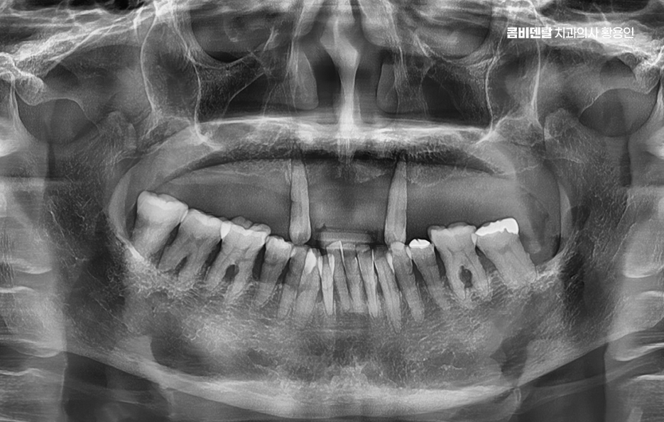 If You’re Considering Full Upper-Arch Implants for the Long Term image 2