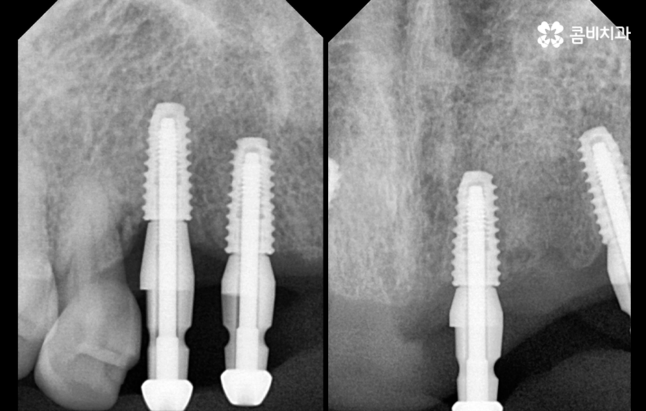 앞니임플란트 이런 조건들을 따져보세요 관련 이미지 4