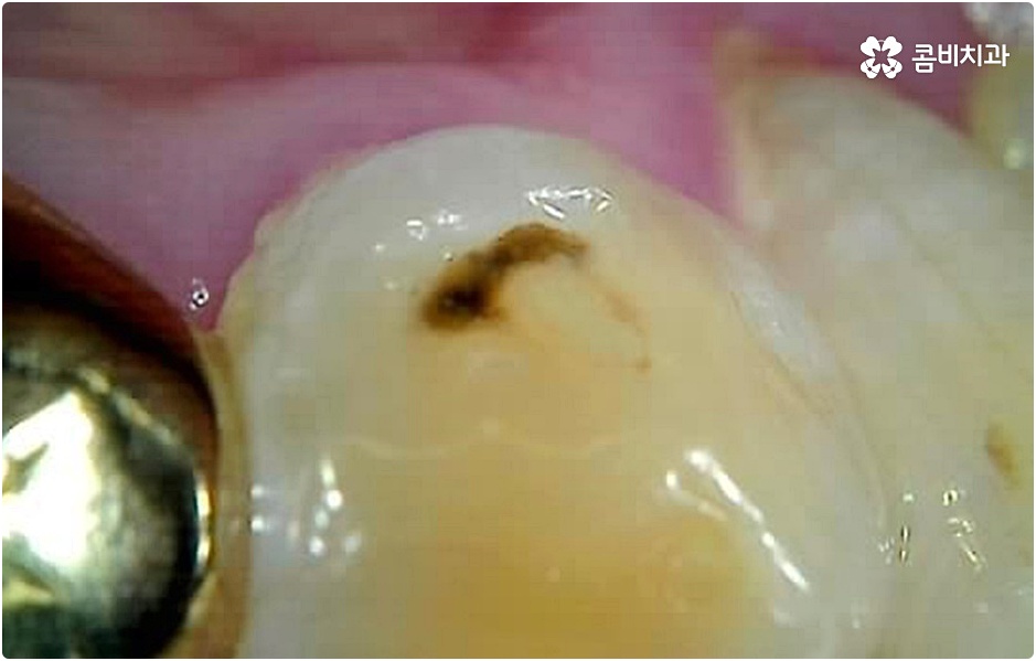 20대임플란트 남의일이 아니라면 관련 이미지 9