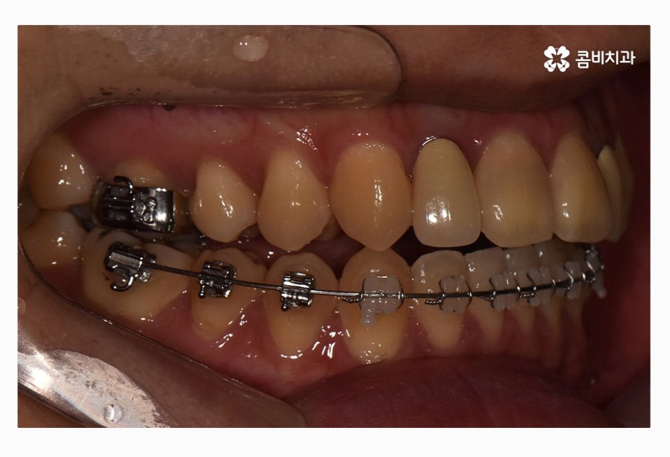 콤비교정 올바르게 판단하려면 관련 이미지 12