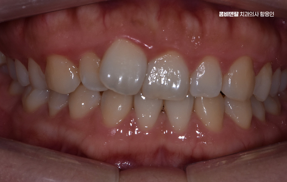 치아교정 통증 줄이는 방법 어떻게 가능할까요 관련 이미지 1