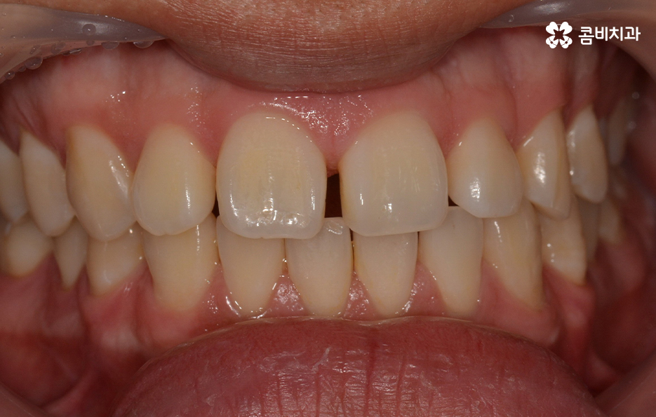 치아부분교정 내게도 적합한지 알아보려면 관련 이미지 3