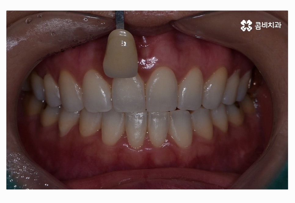 누런이로 고민하시는 분들을 위한 치아미백 정보 관련 이미지 3