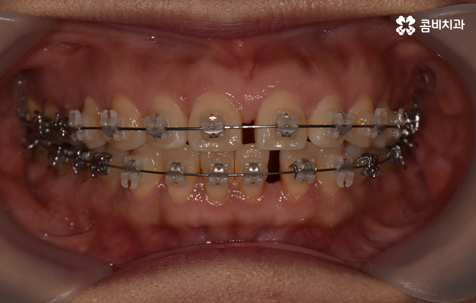 중년치아교정 이제라도 해도 될까요 관련 이미지 7