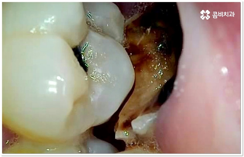 어금니 충치치료 빠를수록 좋아요 관련 이미지 8