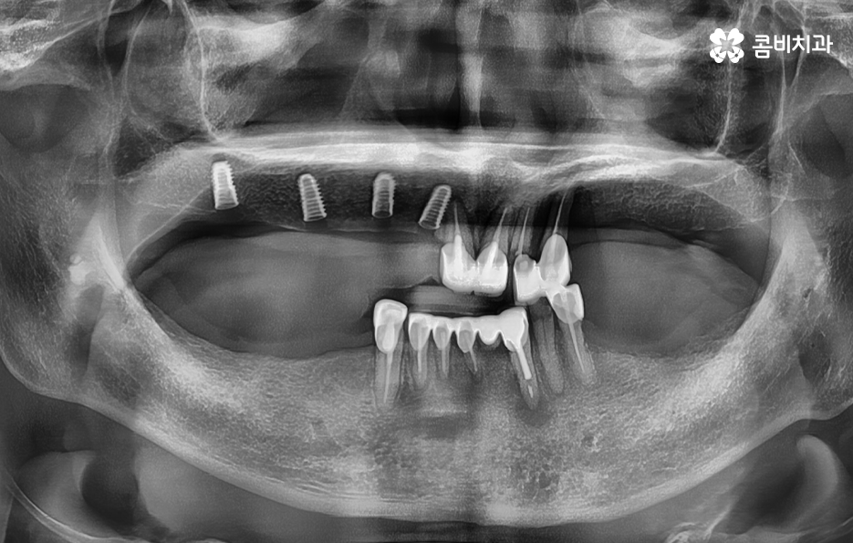임플란트 나이 얼마나 영향을 줄까 관련 이미지 3