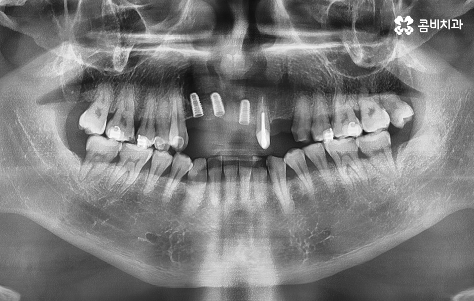 앞이빨 임플란트 과정 주의해야할 포인트는 관련 이미지 5