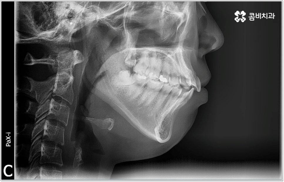 비발치치아교정 언제 할수있나요 관련 이미지 1