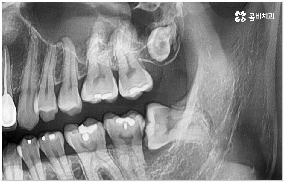 치아 사이 충치 어떻게 하나요 관련 이미지 4