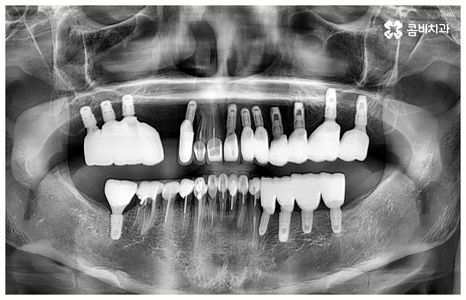 임플란트 치료기간 중점을 두어야 할것은 관련 이미지 10