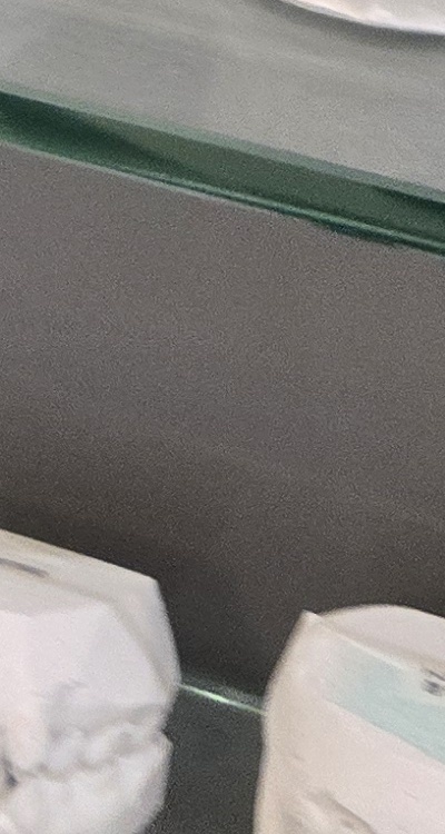 윗니 전체 임플란트 뭐부터 해야할까 관련 이미지 45