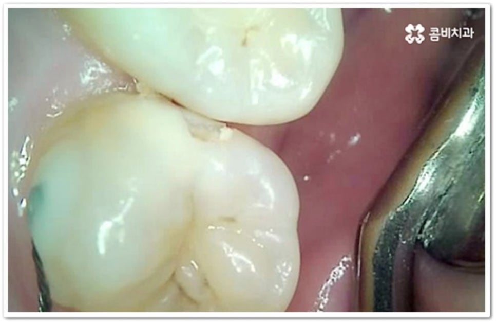 인접면 충치 어떻게 하나요 관련 이미지 3