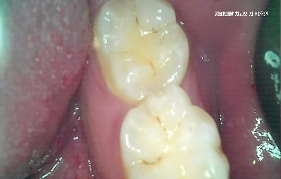 사랑니 발치 후 충치 치료 둘다 준비하려면 관련 이미지 5