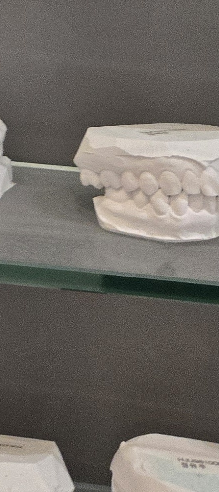 앞이빨 임플란트 과정 주의해야할 포인트는 관련 이미지 33