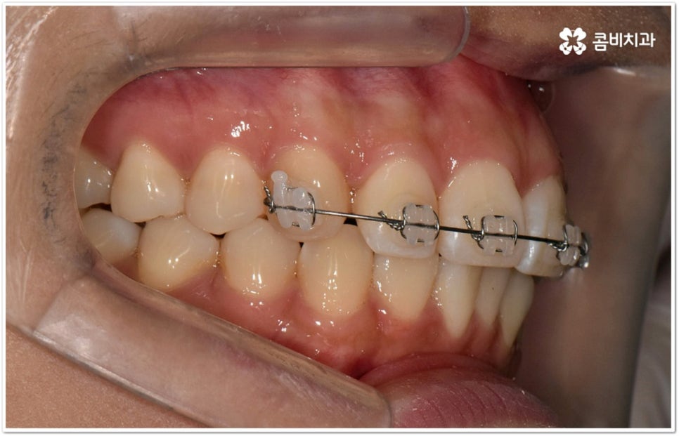 덧니부분교정 시작하려면 관련 이미지 10
