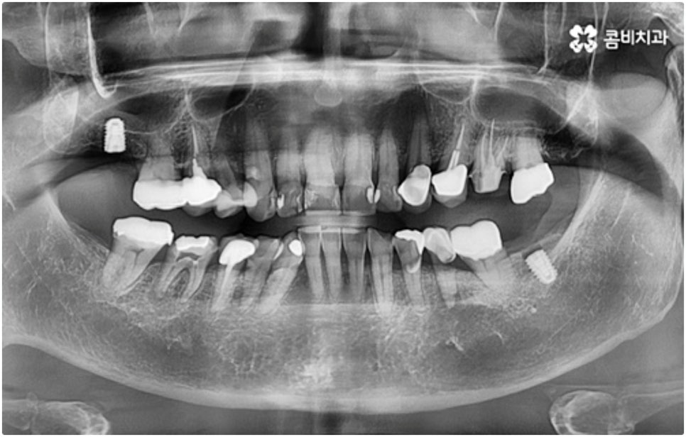 어금니임플란트 살펴볼 사항들은 무엇인가요? 관련 이미지 4