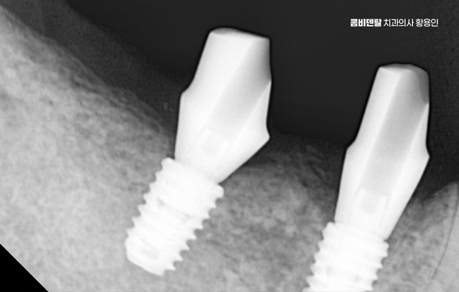 어금니 발치후 임플란트 안하면 어떻게 변하는걸까 관련 이미지 11