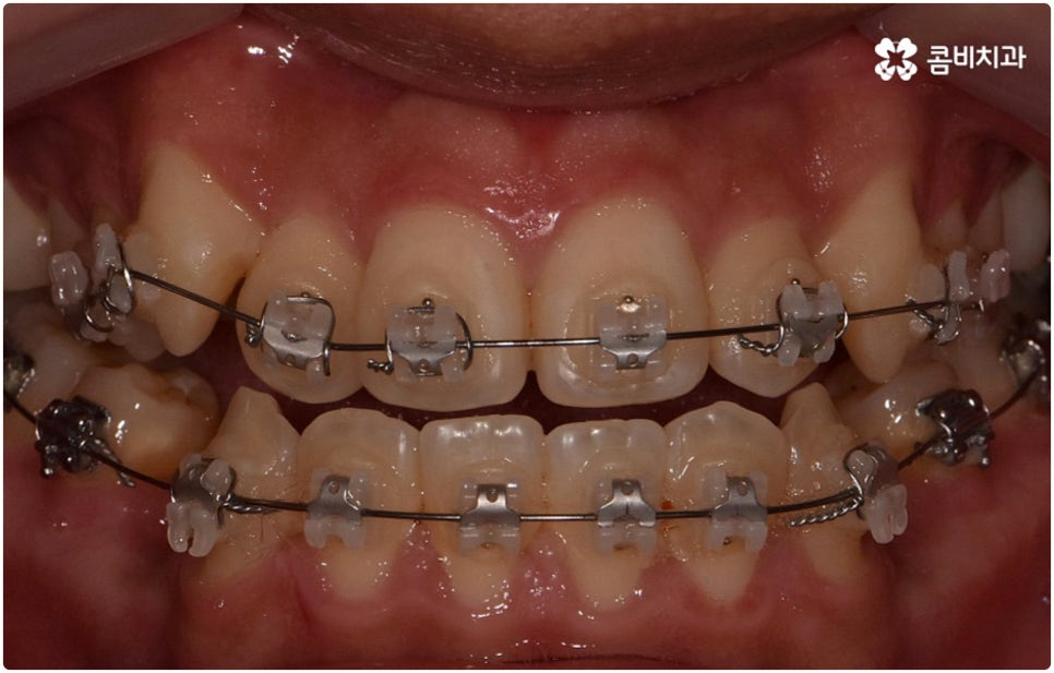 부정교합 3급 고치는 방법은 관련 이미지 6