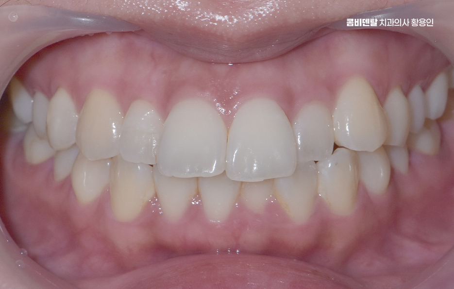 Could the Cause of Protruding Front Teeth Make a Difference? image 2