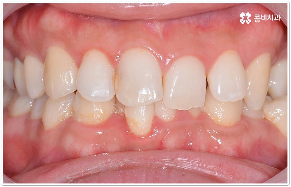 클리피씨교정 합리적인 초이스! 관련 이미지 3